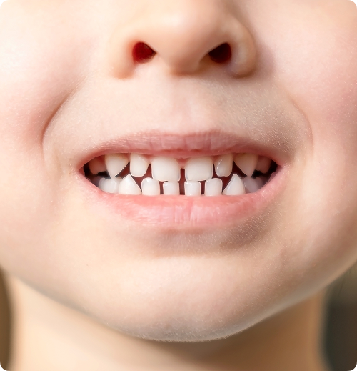 Carie de la petite enfance