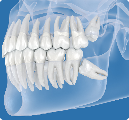 Extraction des dents de sagesse