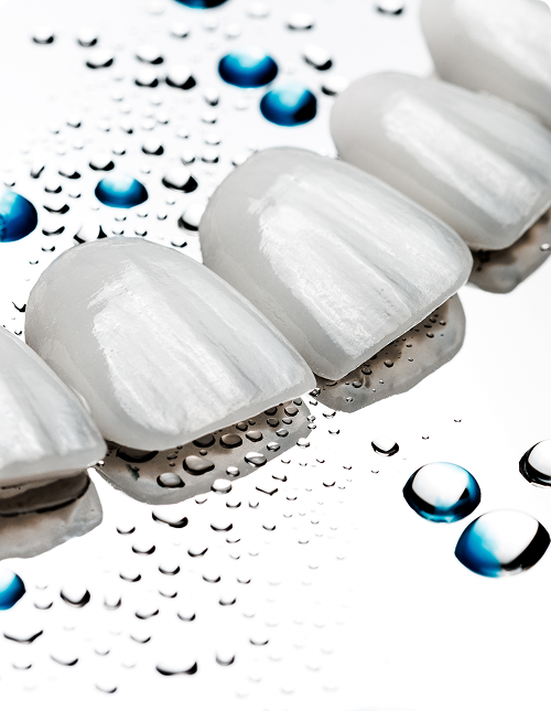 Facettes en composite : accessibles et rapides