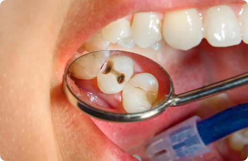 Le traitement d’une carie vise à retirer la portion endommagée de la dent, puis à la restaurer avec un matériau de comblement. 