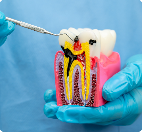 Pourquoi faut-il parfois faire un traitement de canal ?