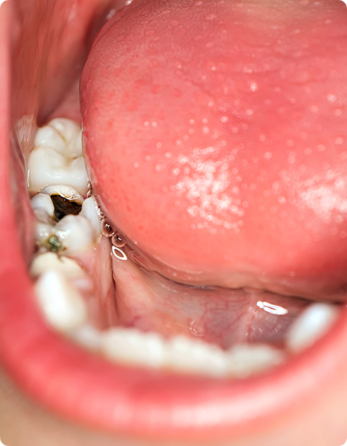 Qu’est-ce que la carie de la petite enfance ?