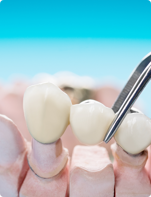 Qu’est-ce qu’un pont dentaire ?