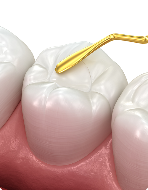 Qu’est-ce qu’un scellant dentaire ?