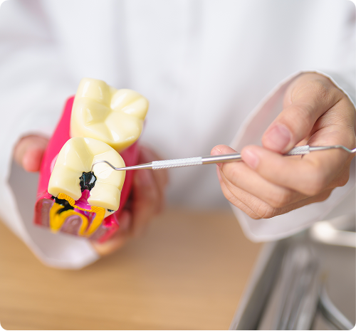 Qu’est-ce qu’une carie dentaire ?