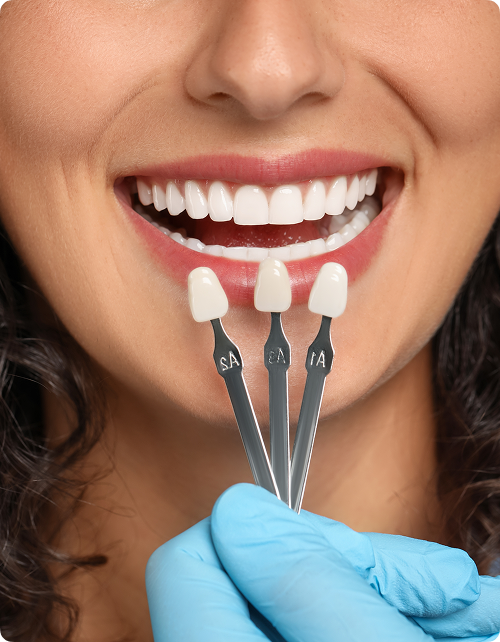 Qu’est-ce qu’une facette dentaire ?