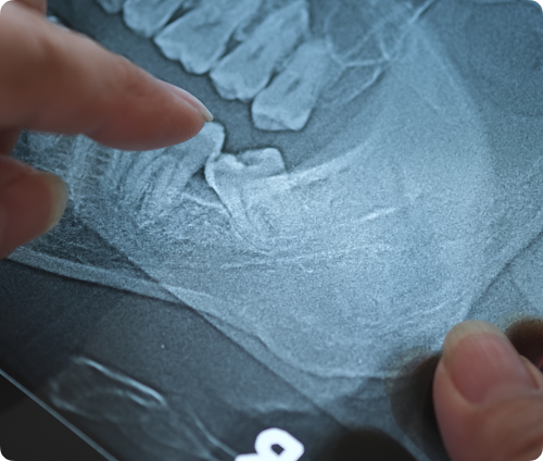 Une extraction peut être recommandée lorsque des problèmes se sont déjà manifesté